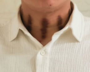 扭痧图片_百度百科