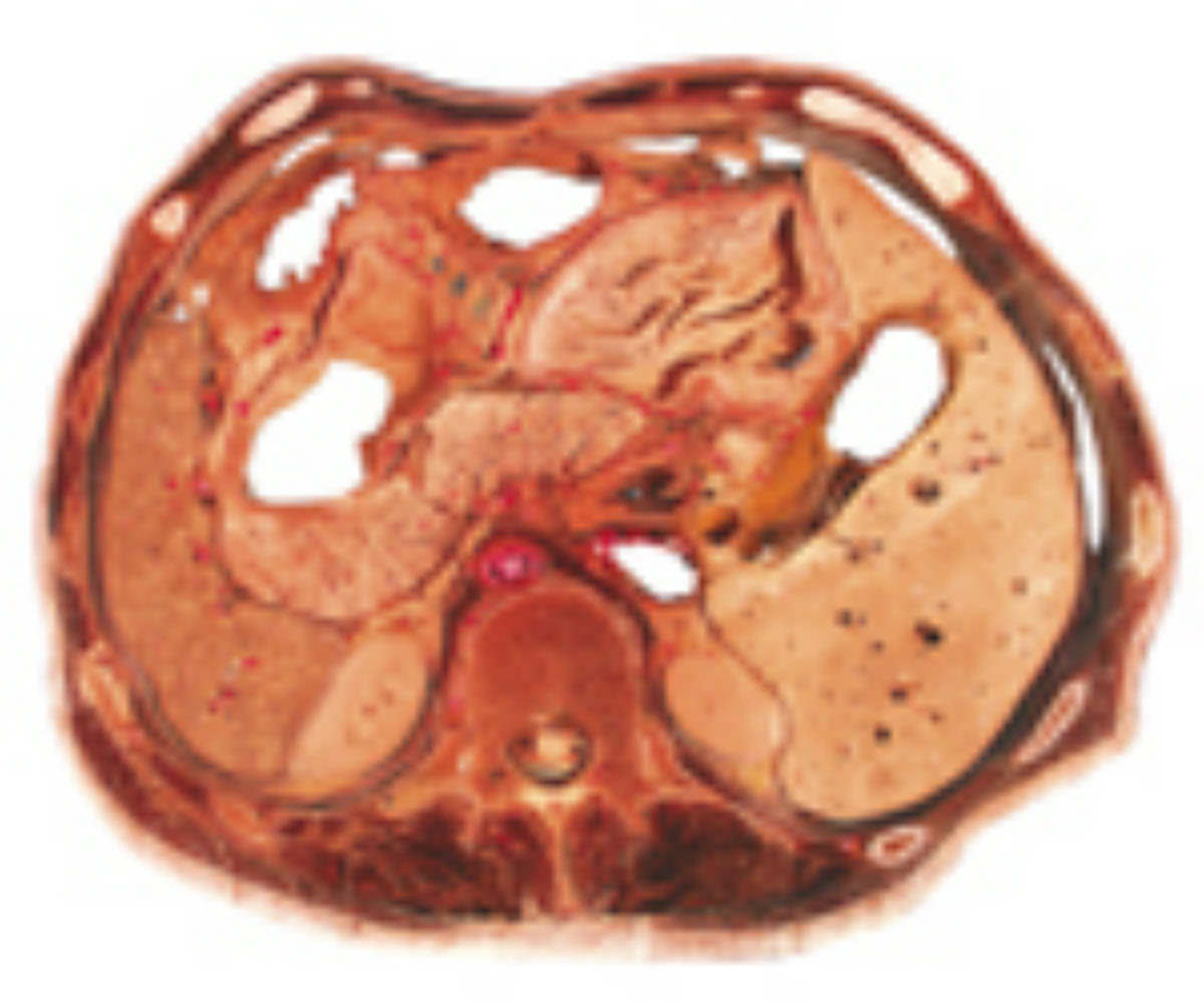  p data-id="gnbpj6uy55">网膜孔,亦称温斯劳孔,是网膜囊向右通入腹膜