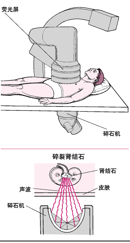 体外碎石术