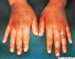 多形性渗出性红斑 是一种原因不明的急性病,以发热开始,肢体出现对称