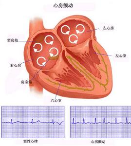  p>阵发性心房颤动是由于多重折返小波引起间歇性快速而不规则的心房