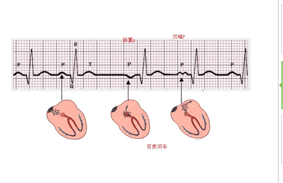 窦房结内游走心律
