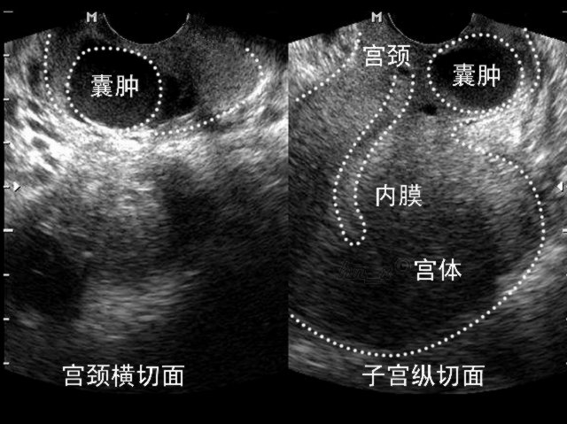  p>宫颈潴留囊肿是女性 a target="_blank" href="/item/慢性宫颈炎