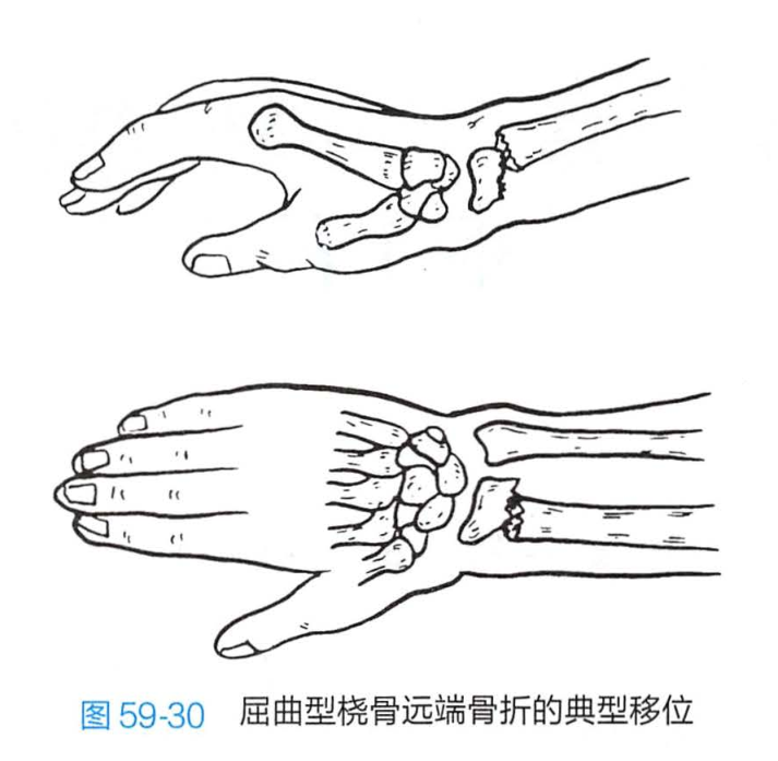 桡骨远端骨折