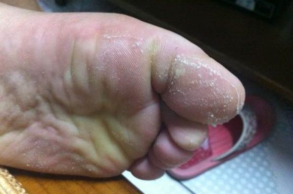  p>烂脚丫是由于真菌引起的脚部皮肤发炎,很痒,会出现水疱,而且随着