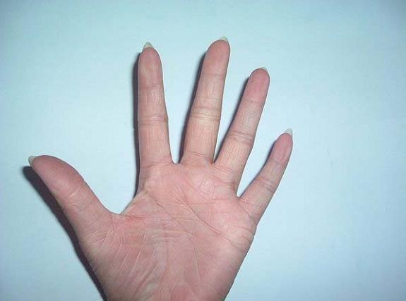  p>寻常型鱼鳞病(ichthyosis vulgaris) 此型最常见,一般冬重夏轻.