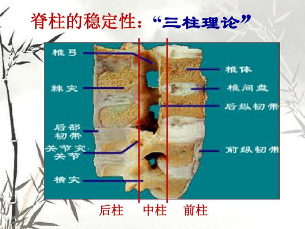 二柱理论的基础上创立了三柱理论学说,强调韧带对脊柱稳