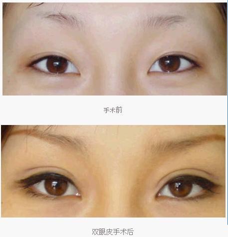  p>三点定位双眼皮,也称为韩式三点双眼皮.