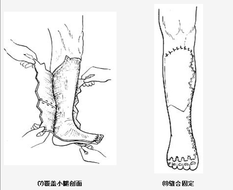 肿手术 /a>系因 a target="_blank" href="/item/淋巴水肿/5085029"