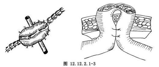 结肠襻状双腔造口术