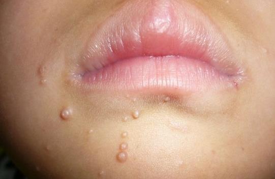 contagiosum)是一种由痘病毒引起的自身接种性病毒性皮肤病