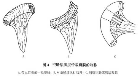 胃十二指肠间置空肠术