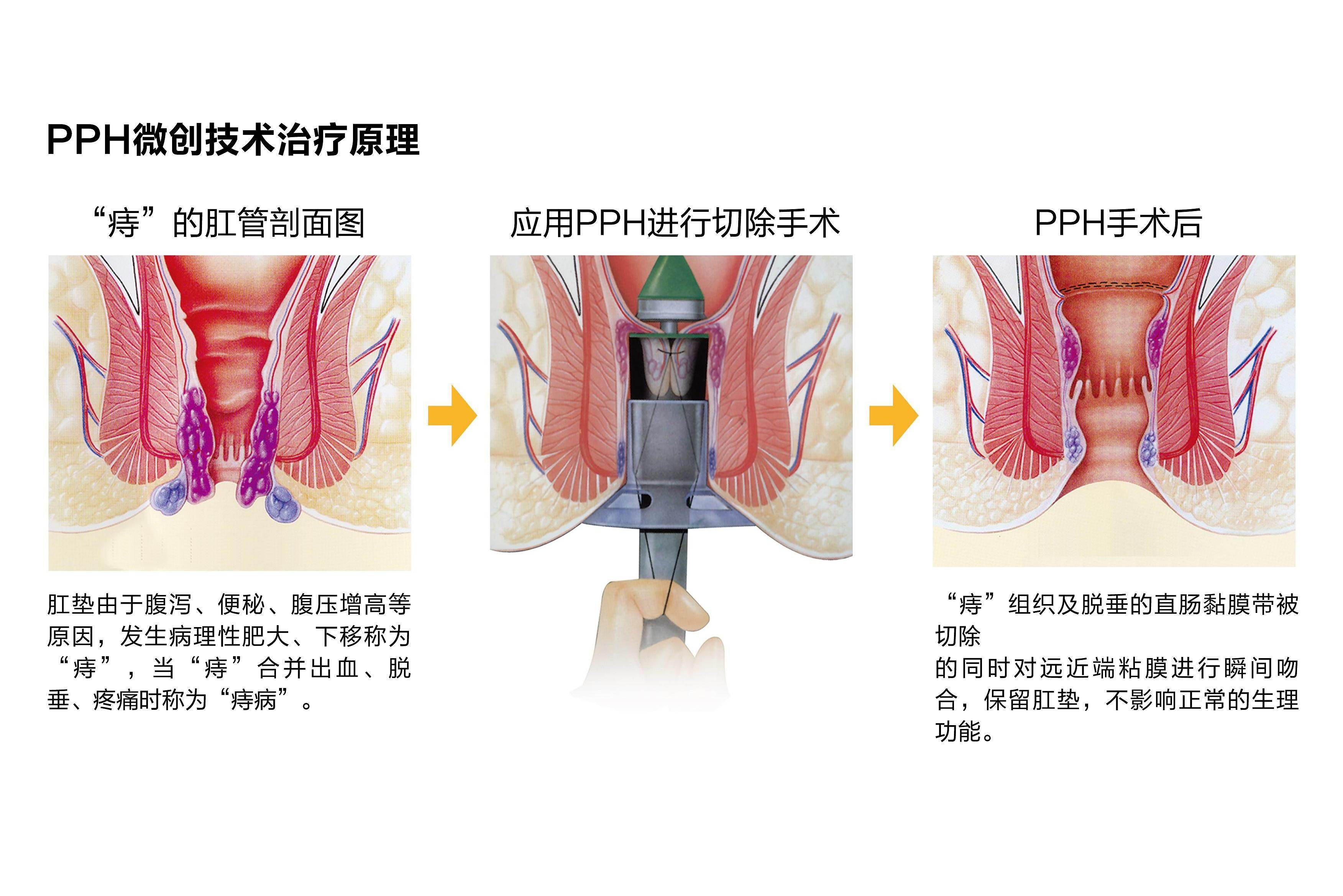 痔疮无痛手术