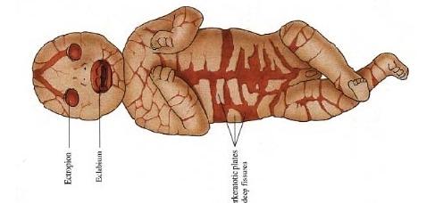 fetus)亦称胎儿 a target="_blank" href="/item/鱼鳞病">鱼鳞病 /a>