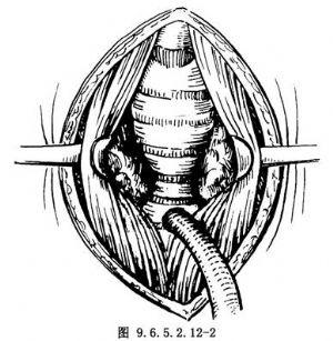 气管楔状切除吻合术