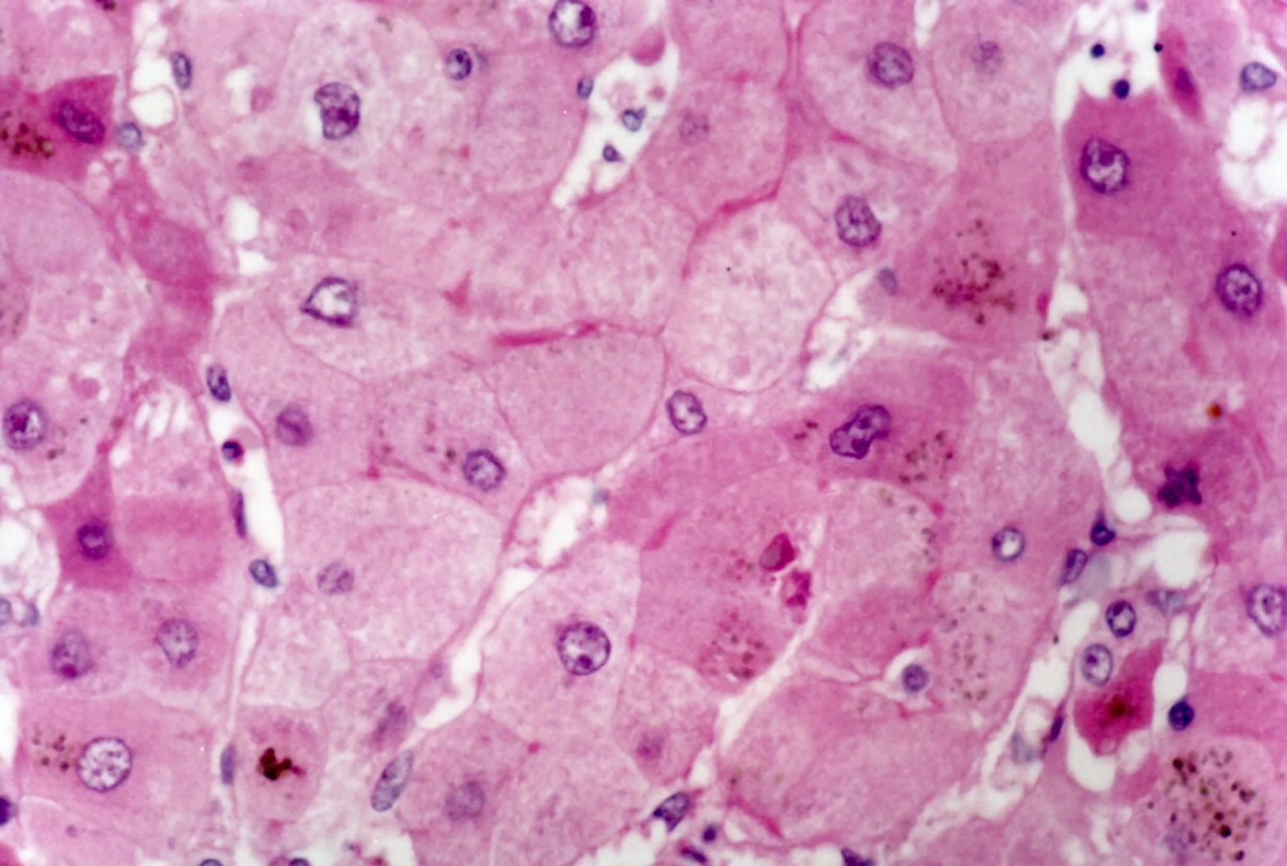 嗜酸性变多累及单个或几个<a target="