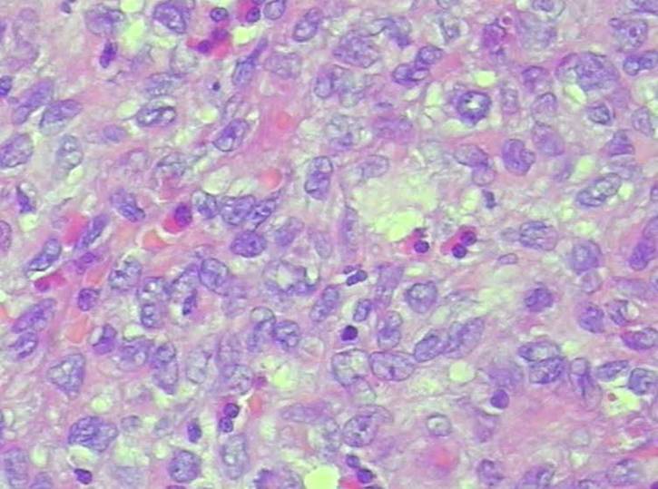 朗格汉斯细胞组织增生症