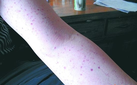 844bf">血小板减少性紫癜是一种免疫性综合病征,是常见的出血性疾病