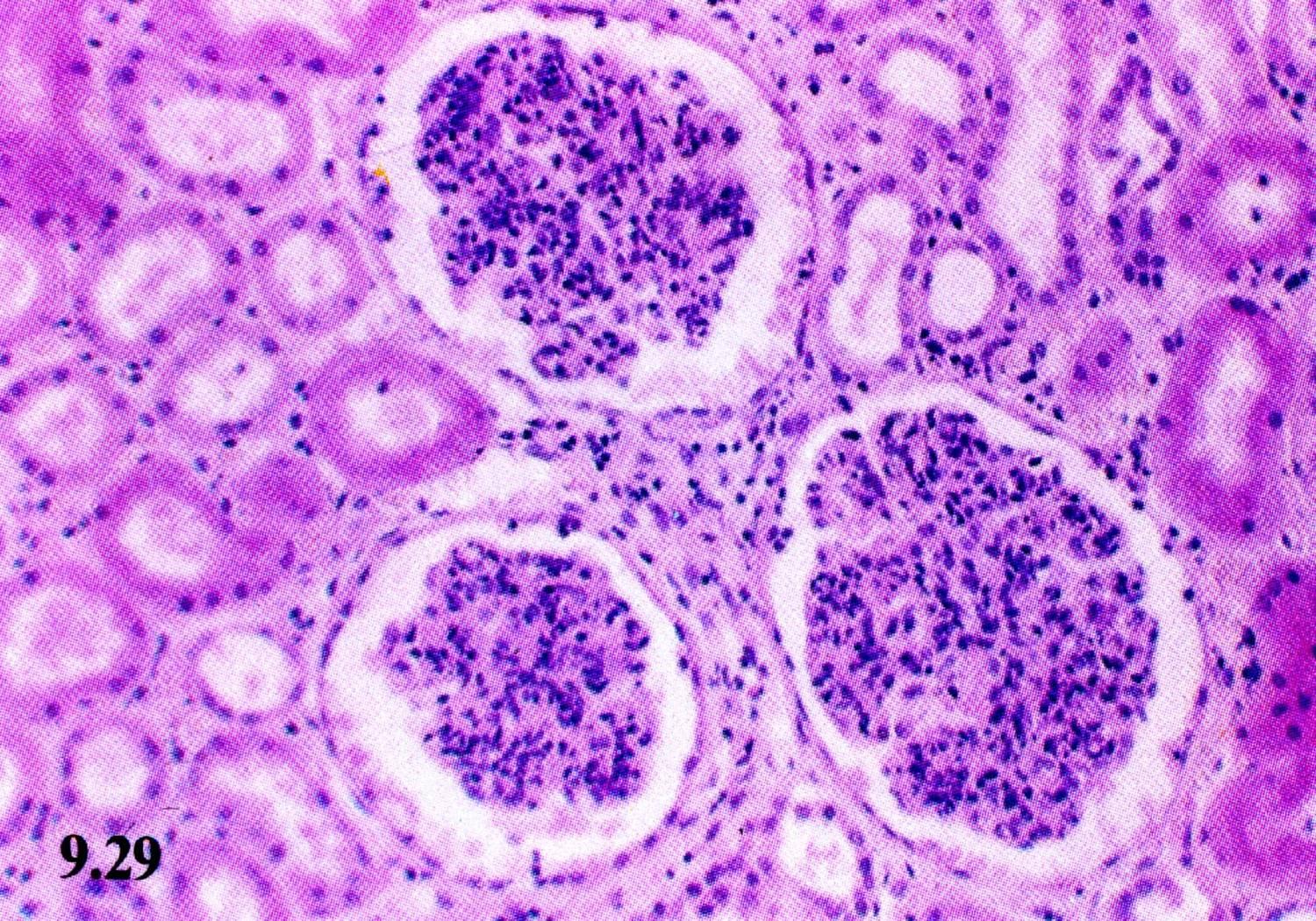 特发性急性小管间质性肾炎