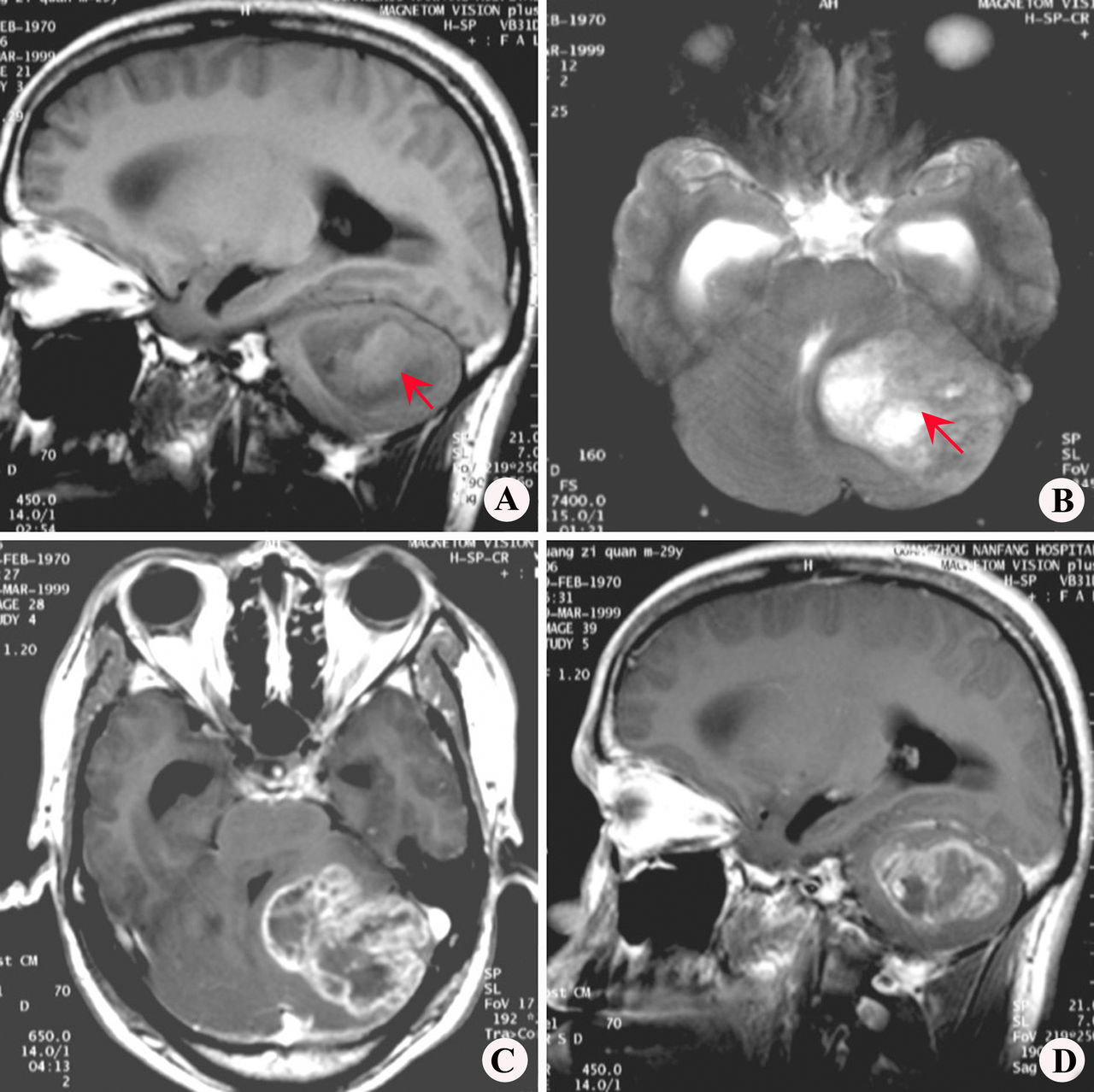 星形胶质细胞瘤(astrocytome)