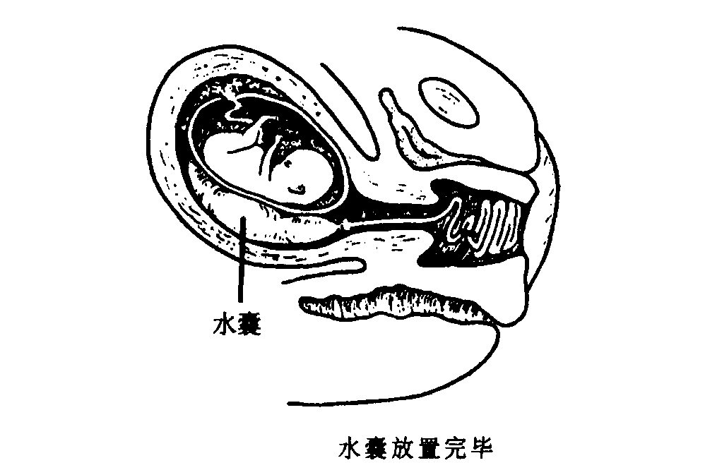  p data-id="gncojn3v34">水囊引产是将水囊放置在于宫壁和 a target=