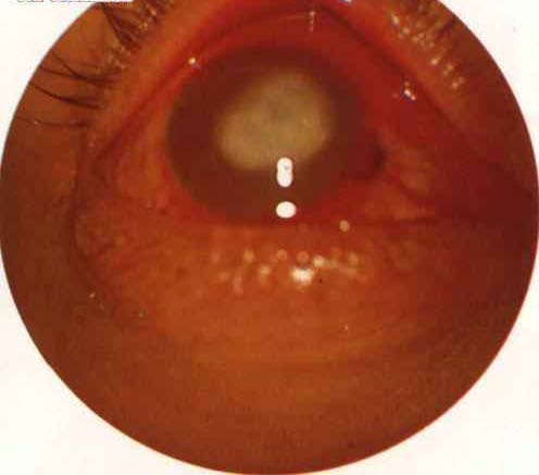 单纯疱疹性巩膜炎