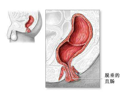 直肠完全脱垂