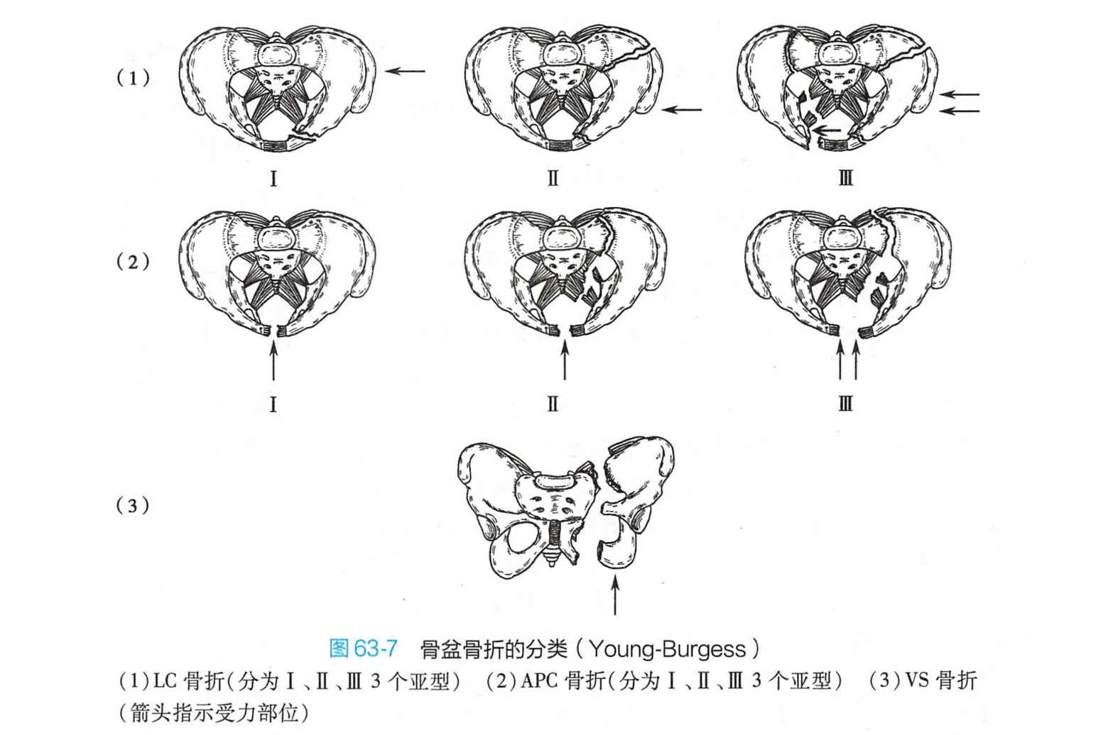 骨盆骨折