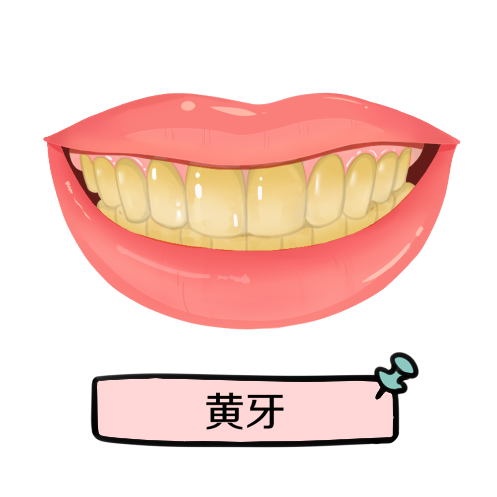  p>色素牙是因饮食,烟茶咖啡等附着于牙齿表面,黄或黑色,有的也是由于