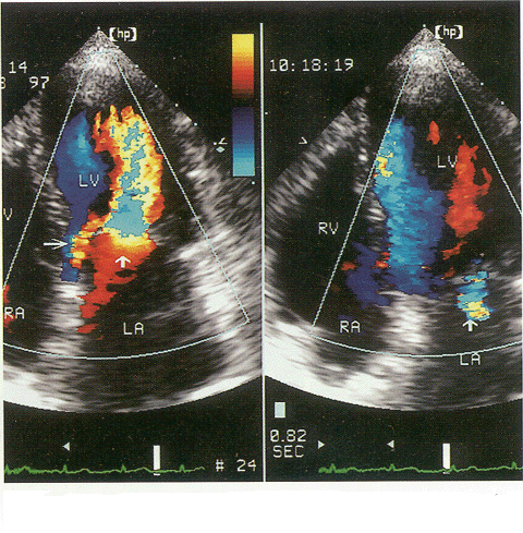 本病特点是肝内,外胆道的广泛纤维化,其管壁明显增厚而管腔则显著狭窄