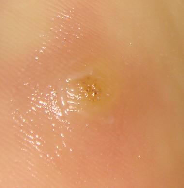  p>跖疣是发生在足跟,跖骨头或跖间的寻常疣,是由乳头瘤病毒所引起的