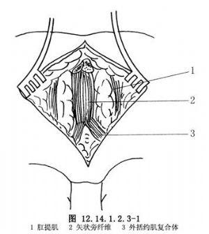 经腹会阴肛门成形术