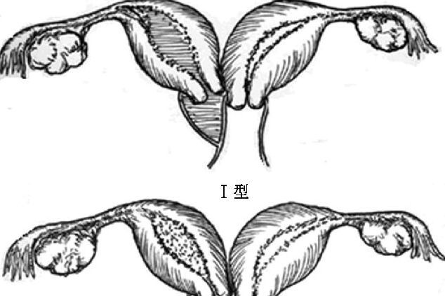 较为常见的一种,因两侧副中肾管会合后,中隔部分消失则形成不完全纵隔
