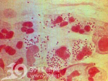 卡他莫拉菌肺炎