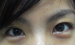  p>眼睛浮肿,是指眼部周围异于平时,外形肿胀突出,有疼痛感,即便眨眼