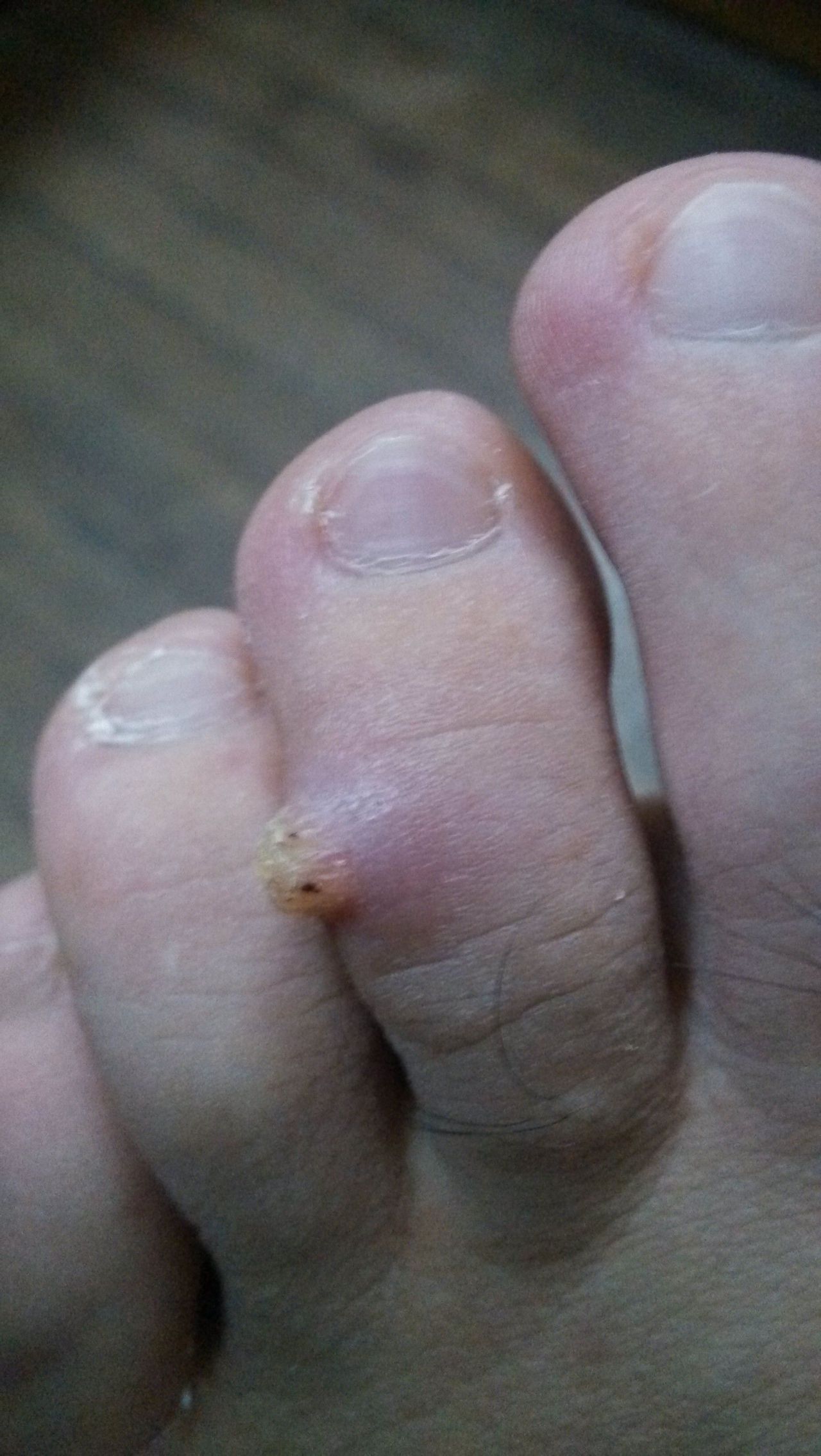  p>鱼痣即鱼鳞痣,究其本质不是一种痣,其实是一种 a target="_blank"