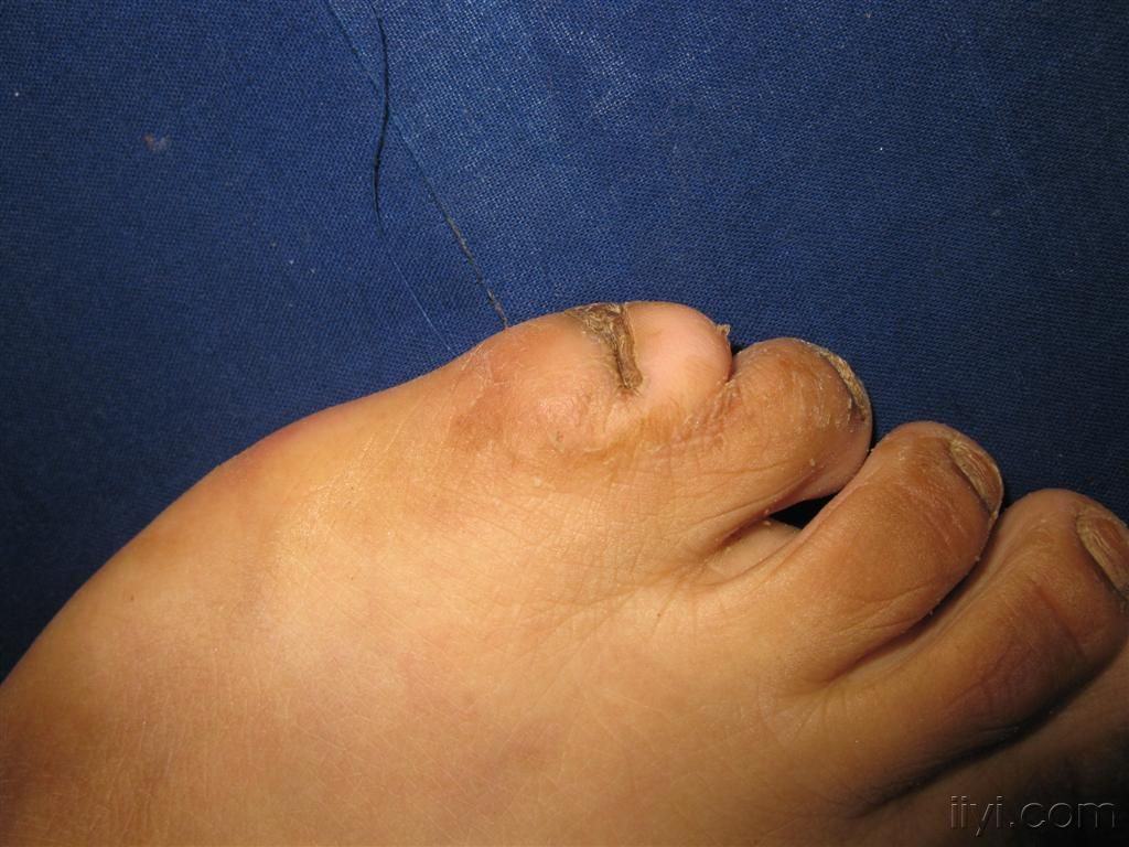  p>并趾是指五趾之间的两只或是两只以上,互相粘连在一起没有独立分开