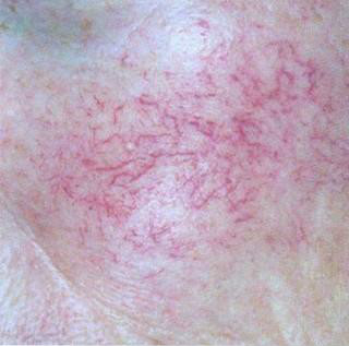  p>红血丝是面部毛细血管扩张性能差, a href="#">角质层 /a>受损或一