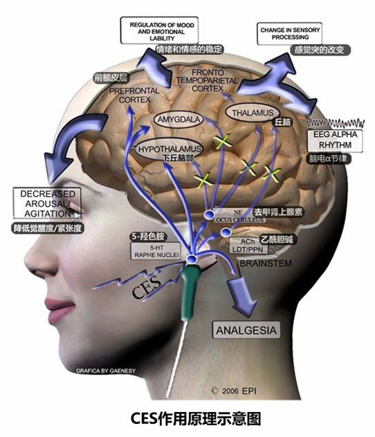  p data-id="gnbkg511ey">经颅微电流刺激疗法(cranial electro