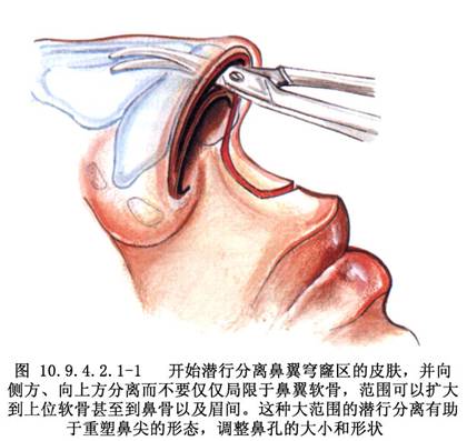 亦可与软骨成形术(整复)及人中再造同