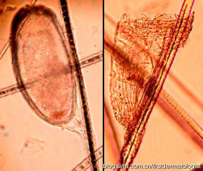  p>姬螯螨属(cheyletiella)的螨虫寄生于皮肤表面,引起轻度非化脓性