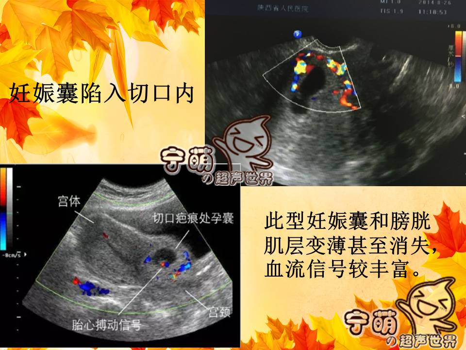 是指有过剖宫产史的女性,在再次妊娠的时候,孕囊着床在子宫原疤痕处