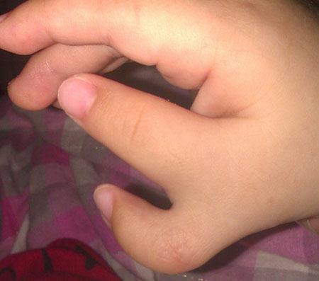  p>六指姆,是指有多指病的人, a href="#" data-lemmaid="10012457">