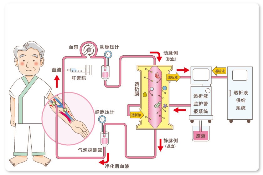  p>血液透析装置是利用半透膜原理,通过弥散,对流和过滤等作用,将患者