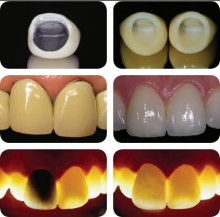 金属烤瓷牙和全瓷牙对比