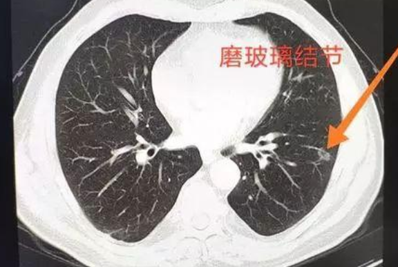 肺部磨玻璃小结节