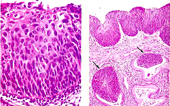 in situ,ccis)首先由broder于1953年提出,1967年richart[1]认为子宫颈