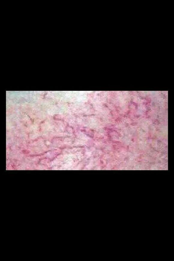  p>脸部红血丝是由于面部 a target="_blank" href="/item/毛细血管