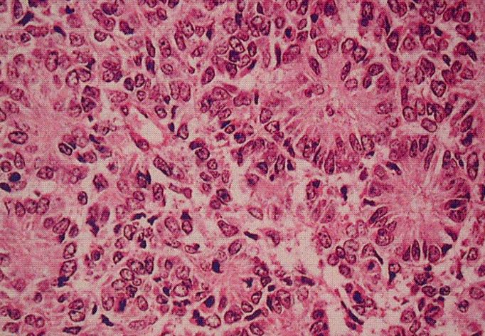  p>是骨髓肿瘤,其组织形态学表现为不具分化特点的小圆形细胞,发生