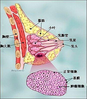  p data-id="gnapkgm521">原位导管癌,乳腺癌0期,肿瘤细胞仅局限在